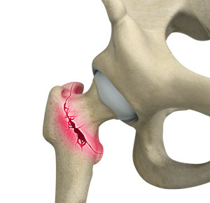 Intertrochanteric Fractures