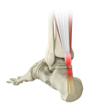 Achilles Tendon Rupture