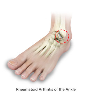 Ankle Rheumatoid Arthritis