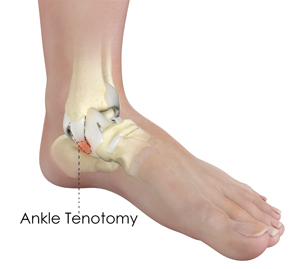 Ankle Tenotomy