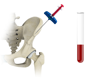 Bone Marrow Aspirate Concentrate (BMAC) Treatment