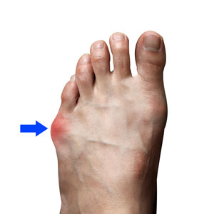 Bunionette (Tailor's Bunion)