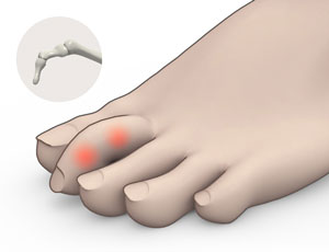 Congenital Deformity and Clubfoot