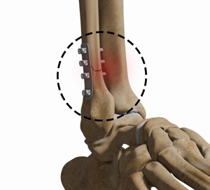 Complex Foot and Ankle Surgeries