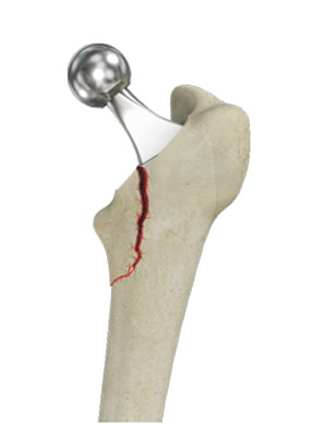 Femur Fracture 