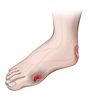 Foot Infections