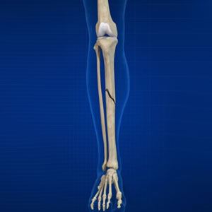 Fractures of The Tibia