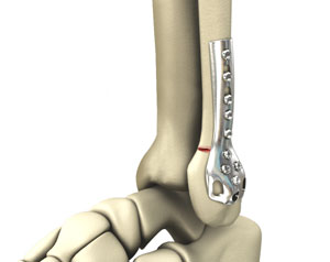 Internal And External Fixation Of Foot And Ankle Fractures