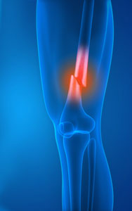 Femoral Shaft Fractures