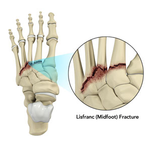 Lisfranc (Midfoot) Injury