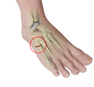 Metatarsal And Phalangeal (Forefoot) Fractures