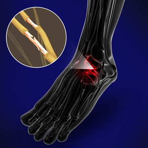 Nerve Conditions of the Foot