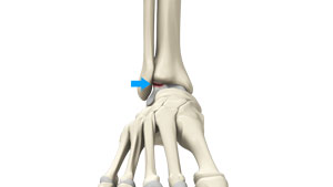 Osteochondral Injuries of the Ankle