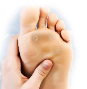 Plantar Warts