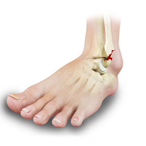 Stress Fractures of Foot and Ankle