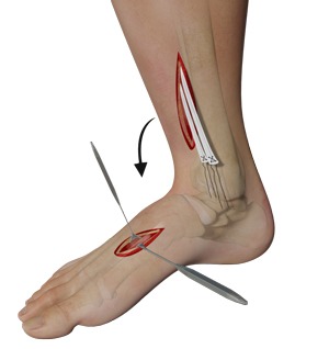 Tendon Transfer