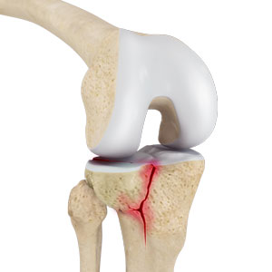 Tibial Plateau Fractures