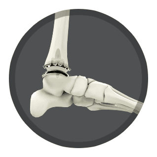 Ankle Joint Replacement